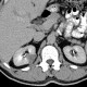 Cystic nephroma, Perlmann's tumour: CT - Computed tomography